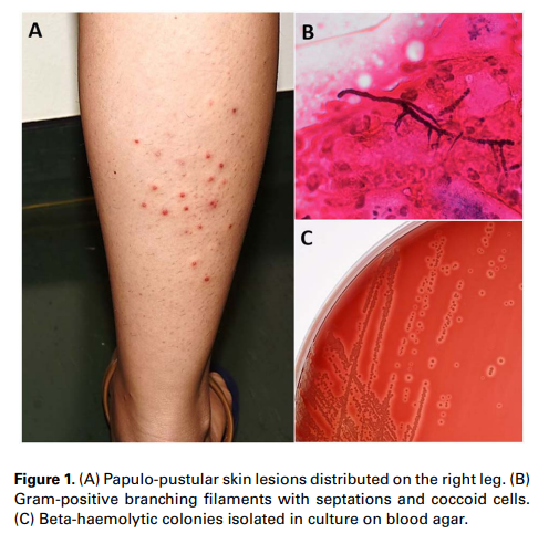 #unaimagentropi

🐘Peligros de montar en elefante: Dermatophilus congolensis
academic.oup.com/jtm/article/28…