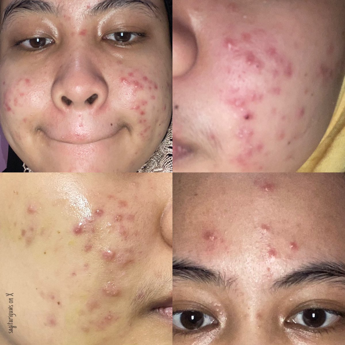 sagitariyuws's tweet photo. kaya ngimpi bisa ngelewatin masa itu, berkali2 coba produk ini itu dari A-Z dan masyaAllah akhirnya😭🤍 https://t.co/mln3qsl8yo