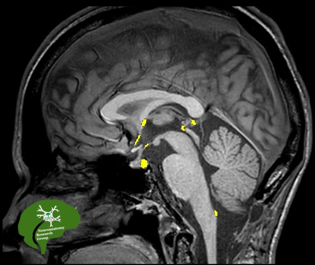 Neuroanatomy Research group (@neuroanatomyrg) on Twitter photo The circumventricular organs (CVOs):
๐๐ซ๐๐ฐ ๐ฏ๐ฌ. ๐๐๐
- specialized structures located around the 3สณแต & 4แตสฐ ventricles.
- Thy lack the blood-brain barrier (BBB).
1. ๐๐ฎ๐๐๐จ๐ซ๐ง๐ข๐๐๐ฅ Organ (SFO): monitors osmolarity and blood pressure (e.g., angiotensin II), The circumventricular organs (CVOs):
๐๐ซ๐๐ฐ ๐ฏ๐ฌ. ๐๐๐
- specialized structures located around the 3สณแต & 4แตสฐ ventricles.
- Thy lack the blood-brain barrier (BBB).
1. ๐๐ฎ๐๐๐จ๐ซ๐ง๐ข๐๐๐ฅ Organ (SFO): monitors osmolarity and blood pressure (e.g., angiotensin II),