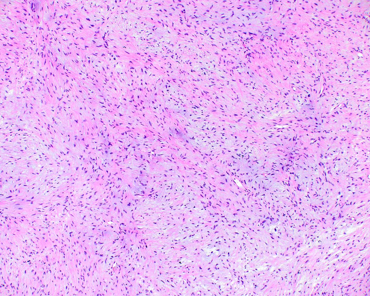 LizMontgomeryMD's tweet photo. Once in a while low-grade fibromyxoid sarcomas are associated with the gastrointestinal tract, as noted years ago by Andrew Folpe and colleagues.
Laurini JA et al. PMID: 21677541. https://t.co/SUKMvqW0ya