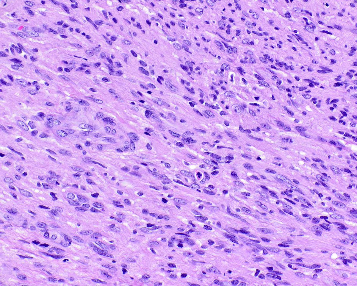 ModernPathology's tweet image. This is a benign epithelioid peripheral nerve sheath tumor (schwannoma) of a digit. Modern Pathology offers some help in sorting out epithelioid skin lesions:
Carter CS, Patel RM. Cutaneous soft tissue tumors: diagnostically disorienting epithelioid tumors that are not…