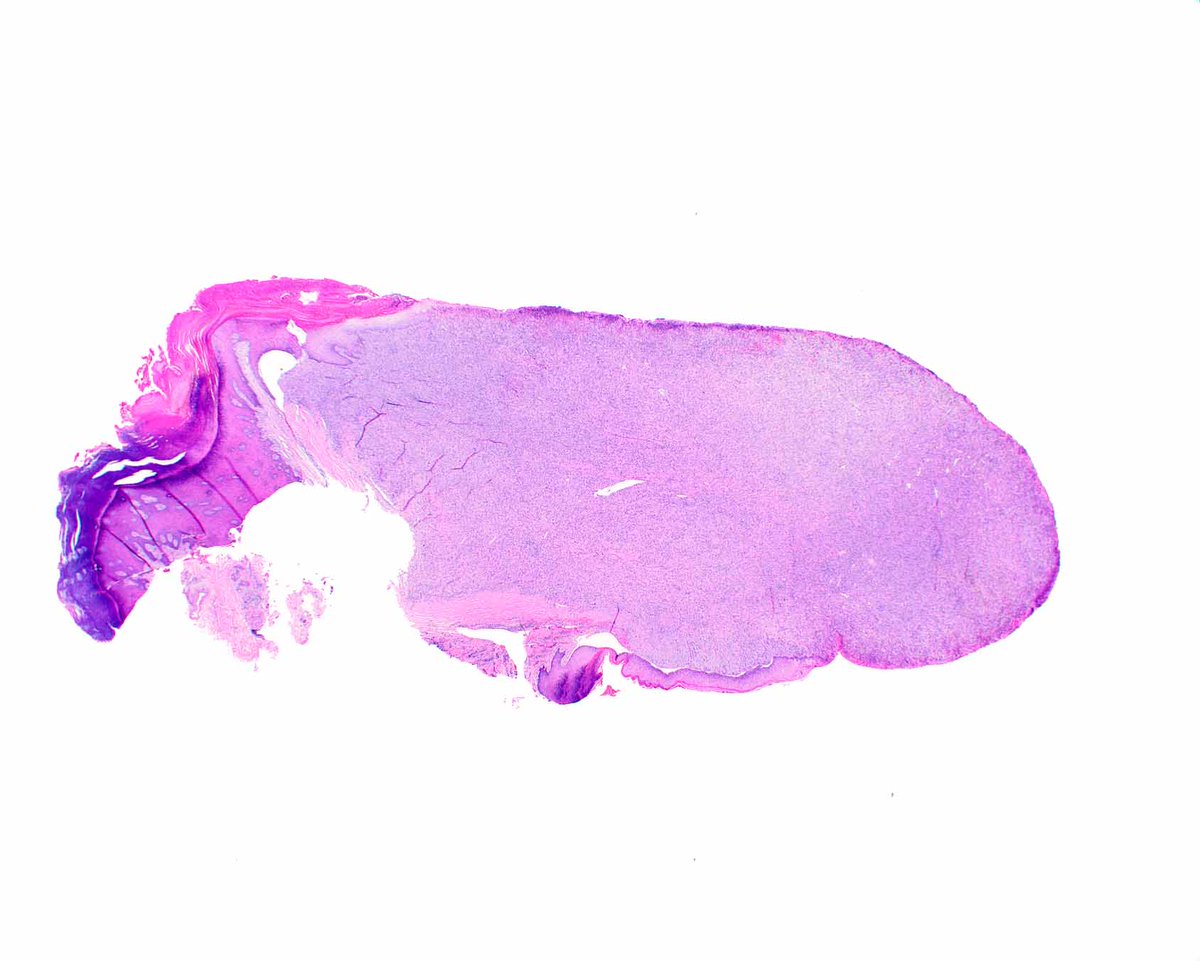 ModernPathology's tweet image. This is a benign epithelioid peripheral nerve sheath tumor (schwannoma) of a digit. Modern Pathology offers some help in sorting out epithelioid skin lesions:
Carter CS, Patel RM. Cutaneous soft tissue tumors: diagnostically disorienting epithelioid tumors that are not…