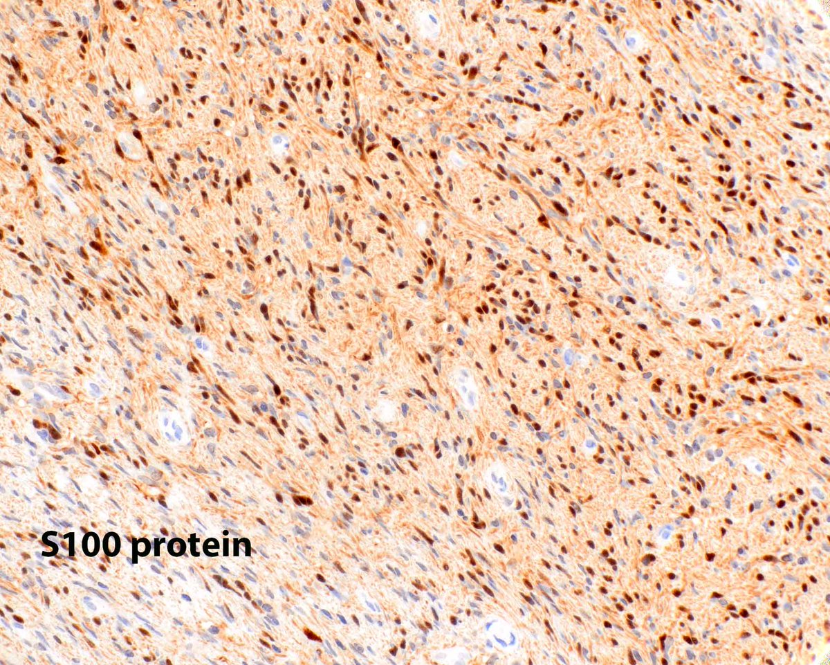 ModernPathology's tweet image. This is a benign epithelioid peripheral nerve sheath tumor (schwannoma) of a digit. Modern Pathology offers some help in sorting out epithelioid skin lesions:
Carter CS, Patel RM. Cutaneous soft tissue tumors: diagnostically disorienting epithelioid tumors that are not…