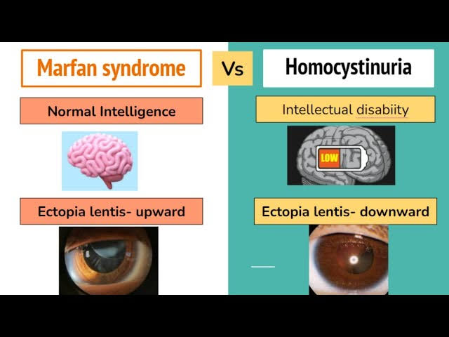DrSarperSaglam's tweet image. 🧠 Marfanoid görünüm + lens subluksasyonu diyorsa:
↖️ Yukarı-dışa kayma = Marfan
↘️ Aşağı-içe kayma + mental retardasyon = Homosistinüri
🎯 TUS’un sevdiği klasik ayırt sorusudur!

 @DrSarperSaglam'ı takip edin. #tus