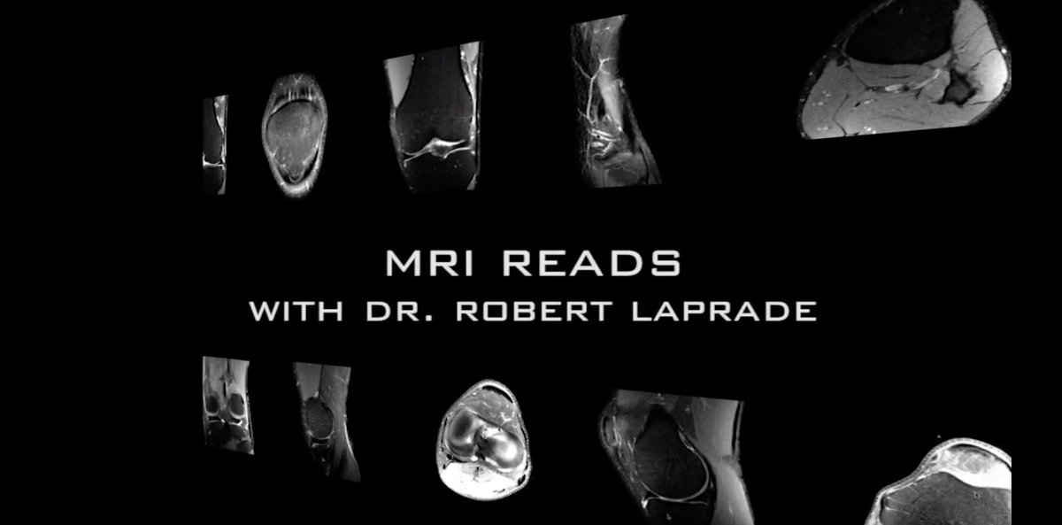 thekneedoc's tweet photo. Ever wonder what an #MCLinjury looks like on #MRI? Dr. LaPrade walks you through a real case after a #skiing accident. https://t.co/xflqh0eEFh #kneeexpert #MRIreview https://t.co/55Vb0vZgsv
