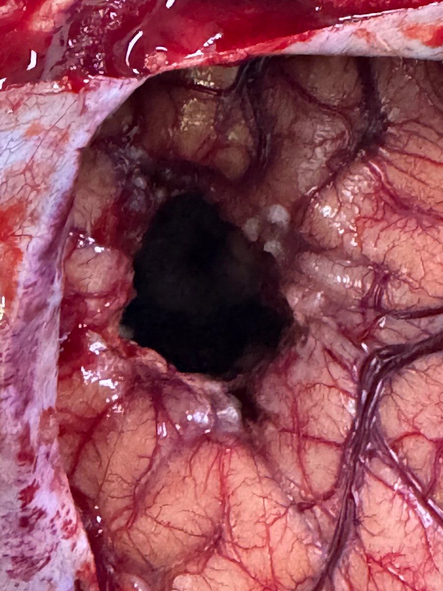 After Brain 🧠 Tumor Removel
See the normal surrounding brain 🧠 and tumor cavity
Good outcome for patient - complete excision of tumor