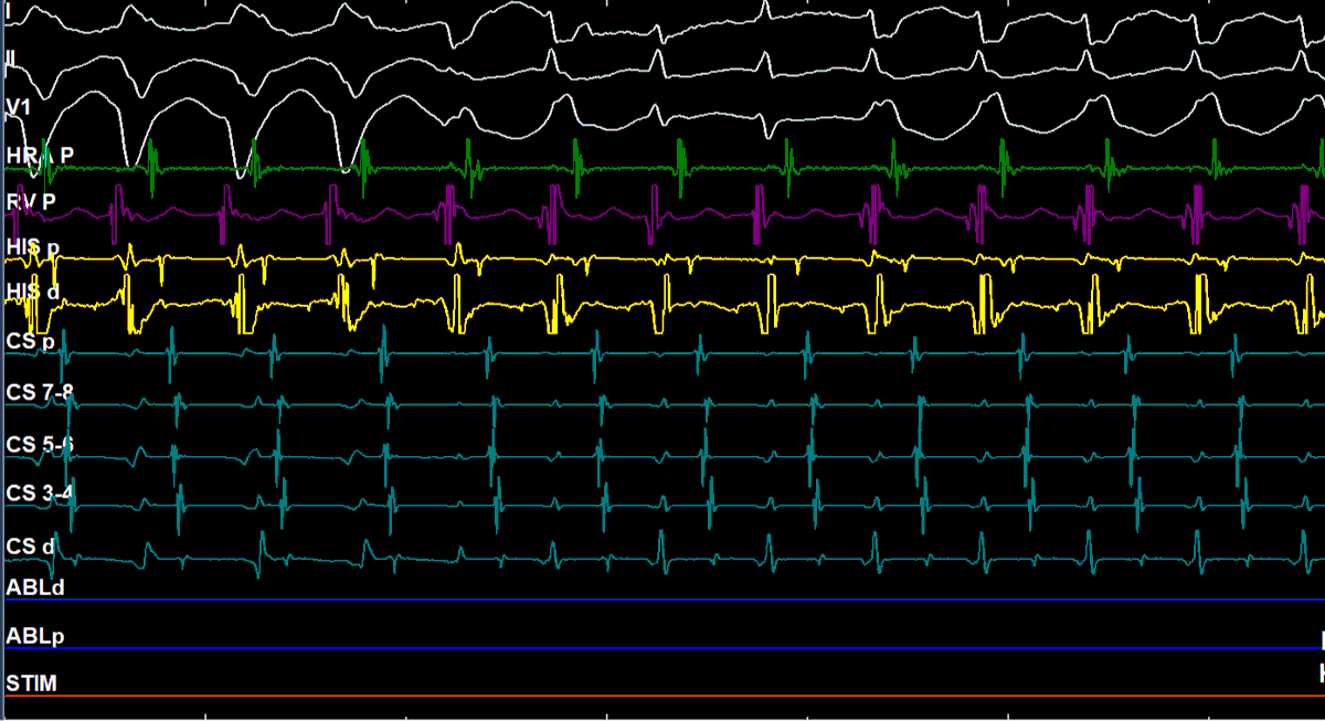 Haseeb Raza FACC, FHRS, FESC, CEPS-A, FCPS EP (@haseebephf) on Twitter photo 🥳What is the most probable mechanism of underlying tachycardia ?
#CardioTwitter #Epeeps #CardioEd #MedEd #MedTwitter
<a href="/escardio/">European Society of Cardiology</a>
<a href="/APHRSOfficial/">APHRS Official</a>
<a href="/ESC_Journals/">European Society of Cardiology Journals</a>
<a href="/HFA_President/">HFAPresident</a>
<a href="/EuropaceEiC/">Europace Editor-in-Chief</a>
<a href="/ehj_ed/">EHJ Editor-in-Chief</a>
<a href="/CircAHA/">Circulation</a>
<a href="/CircHF/">Circ: Heart Failure</a>
<a href="/CirculationEP/">CircEP</a>
<a href="/AHAScience/">AHA Science</a>
<a href="/JACCJournals/">JACC Journals</a>
<a href="/ACCinTouch/">American College of Cardiology</a> 🥳What is the most probable mechanism of underlying tachycardia ?
#CardioTwitter #Epeeps #CardioEd #MedEd #MedTwitter
<a href="/escardio/">European Society of Cardiology</a>
<a href="/APHRSOfficial/">APHRS Official</a>
<a href="/ESC_Journals/">European Society of Cardiology Journals</a>
<a href="/HFA_President/">HFAPresident</a>
<a href="/EuropaceEiC/">Europace Editor-in-Chief</a>
<a href="/ehj_ed/">EHJ Editor-in-Chief</a>
<a href="/CircAHA/">Circulation</a>
<a href="/CircHF/">Circ: Heart Failure</a>
<a href="/CirculationEP/">CircEP</a>
<a href="/AHAScience/">AHA Science</a>
<a href="/JACCJournals/">JACC Journals</a>
<a href="/ACCinTouch/">American College of Cardiology</a>