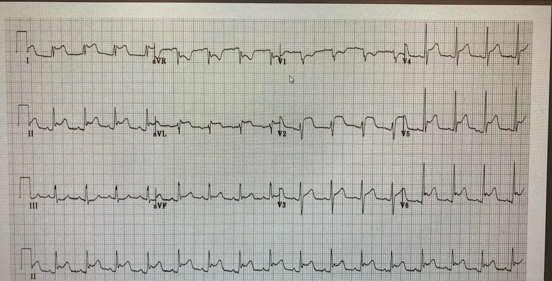 Cath or Not!? 🥺Wraparound or Spodick's! Sign/Checkmark signs?!🥺 Let's talk🫀
<a href="/Ecgloverr/">Pedram</a> <a href="/EM_RESUS/">Sam Ghali, M.D.</a> <a href="/escardio/">European Society of Cardiology</a> <a href="/kisubi_hospital/">Kisubi Hospital</a> <a href="/kirudduNRH/">KIRUDDU NATIONAL REFERRAL HOSPITAL</a> <a href="/TrackYourHeart/">CardiovascularCorner</a> <a href="/Interve15538505/">Interventional Cardiology</a> <a href="/InternalmedMak/">Internal Medicine Residents @Makerere</a> <a href="/smithECGBlog/">Stephen W. Smith</a> <a href="/lacor_hospital/">St. Mary's Hospital Lacor</a> <a href="/UgandaPhysician/">Association of Physicians of Uganda</a> <a href="/Asadthegeek/">Dr.Asad~M[MRCP~UK]</a> <a href="/American_Heart/">American Heart Association</a> <a href="/HeartUganda/">Uganda Heart Institute</a>