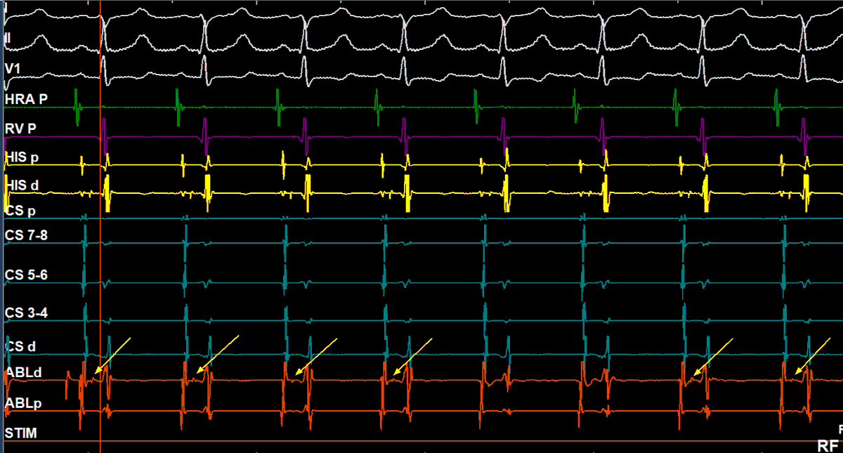 Haseeb Raza FACC, FHRS, FESC, CEPS-A, FCPS EP (@haseebephf) on Twitter photo Here is the Ablation catheter at the site of ablation. Ablation catheter is not at bundle of His. <a href="/melhamriti/">El Hamriti Mustapha</a> , <a href="/ALFIEEP1/">ALBERTO ALFIE</a> , <a href="/pzhong2016/">Dr. Zhong</a> , <a href="/EF_Cardiaca/">EfectoElectrotónico</a> , <a href="/Willis_Kwandou/">Willis Kwandou</a> ... its Atriofasicular pathway, Mahaim fibre tachycardia #mahaim #atriofasicular Here is the Ablation catheter at the site of ablation. Ablation catheter is not at bundle of His. <a href="/melhamriti/">El Hamriti Mustapha</a> , <a href="/ALFIEEP1/">ALBERTO ALFIE</a> , <a href="/pzhong2016/">Dr. Zhong</a> , <a href="/EF_Cardiaca/">EfectoElectrotónico</a> , <a href="/Willis_Kwandou/">Willis Kwandou</a> ... its Atriofasicular pathway, Mahaim fibre tachycardia #mahaim #atriofasicular