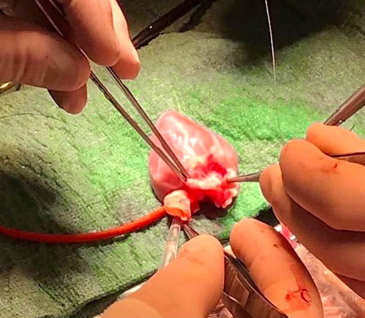 MedicinaOL's tweet photo. Quando un bambino riceve un trapianto di cuore, il nuovo cuore crescerà naturalmente insieme a lui, fino a diventare della normale grandezza di un cuore adulto.
#cuore #trapianto #pediatria #cardiologia #chirurgia #medicina #EmilioAlessioLoiacono #MedicinaOnLine https://t.co/N4NMNSgAsy