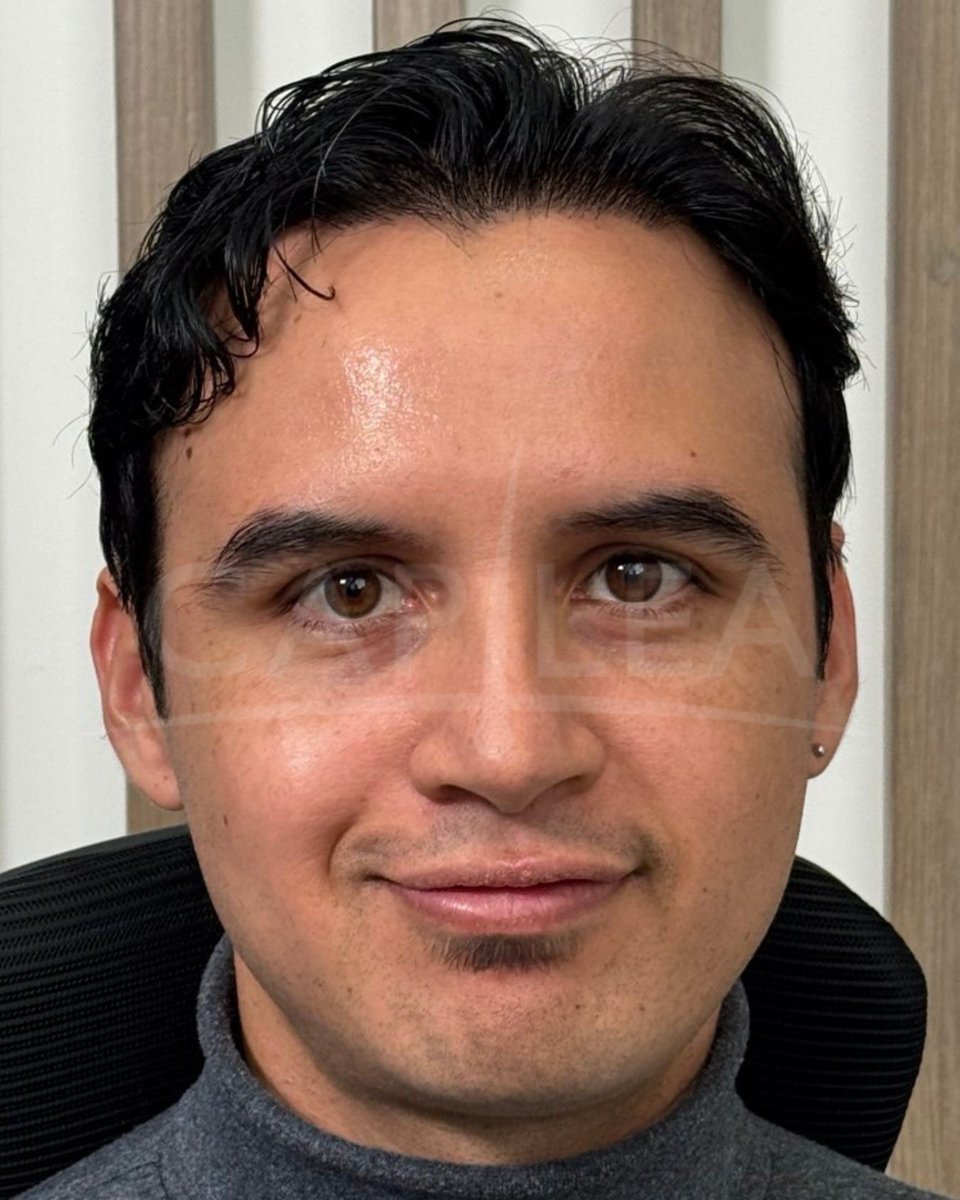 Aviso COFEPRIS 2319012002A00017
#drhectortreviño #capilea #capileamonterrey #hairtrasplant #injertocapilar #microinjertocapilar  #fuetechnique #trasplantecapilar   #capileatijuana #capileacdmx #drhectortrevino #capileamexico #hairtrasplantsurgeon