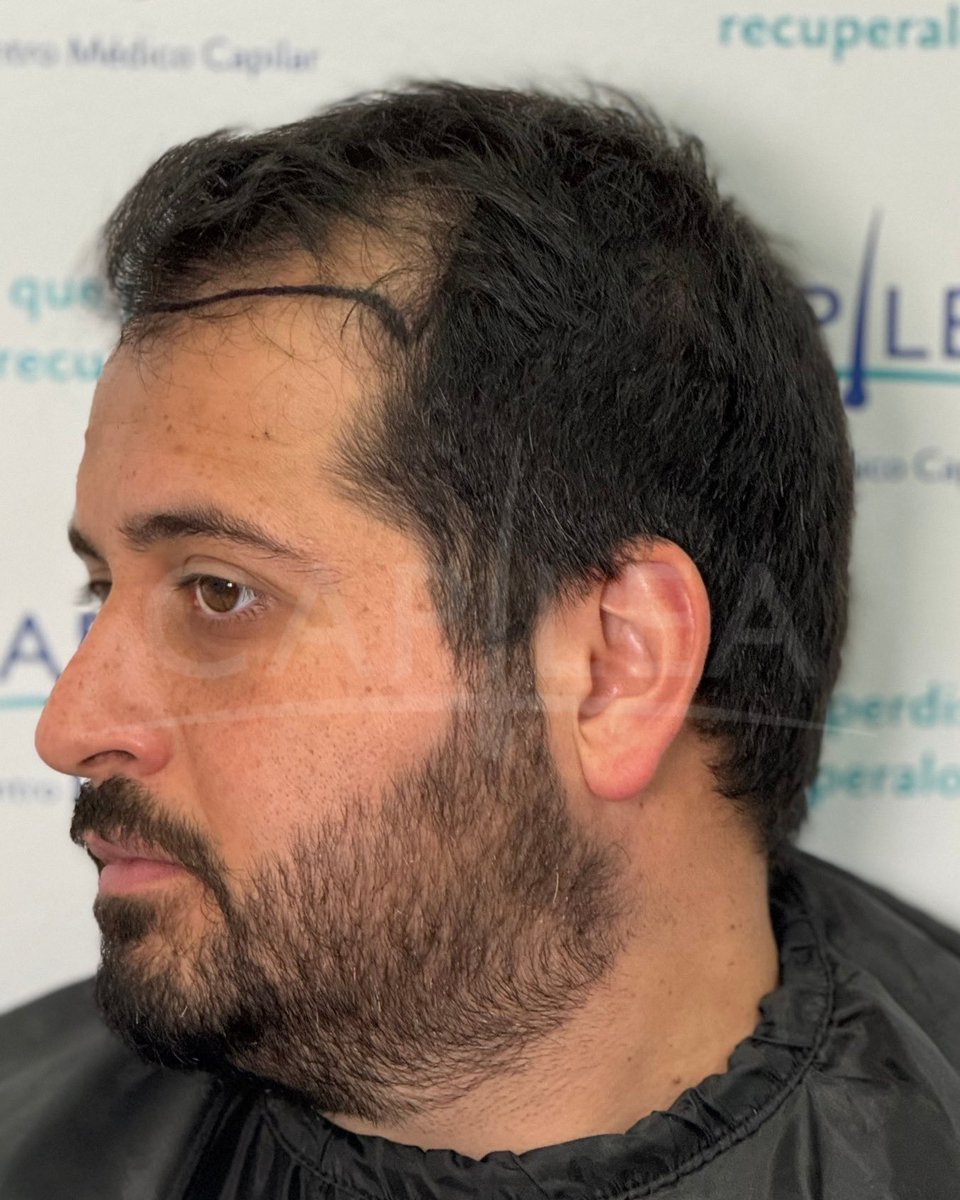 Aviso COFEPRIS 2319012002A00017
#drhectortreviño #capilea #capileamonterrey #hairtrasplant #injertocapilar #microinjertocapilar  #fuetechnique #trasplantecapilar   #capileatijuana #capileacdmx #drhectortrevino #capileamexico #hairtrasplantsurgeon