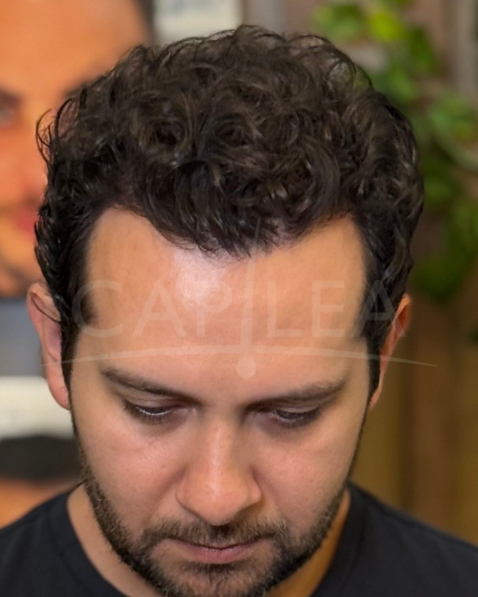 Aviso COFEPRIS 2319012002A00017
#drhectortreviño #capilea #capileamonterrey #hairtrasplant #injertocapilar #microinjertocapilar  #fuetechnique #trasplantecapilar   #capileatijuana #capileacdmx #drhectortrevino #capileamexico #hairtrasplantsurgeon