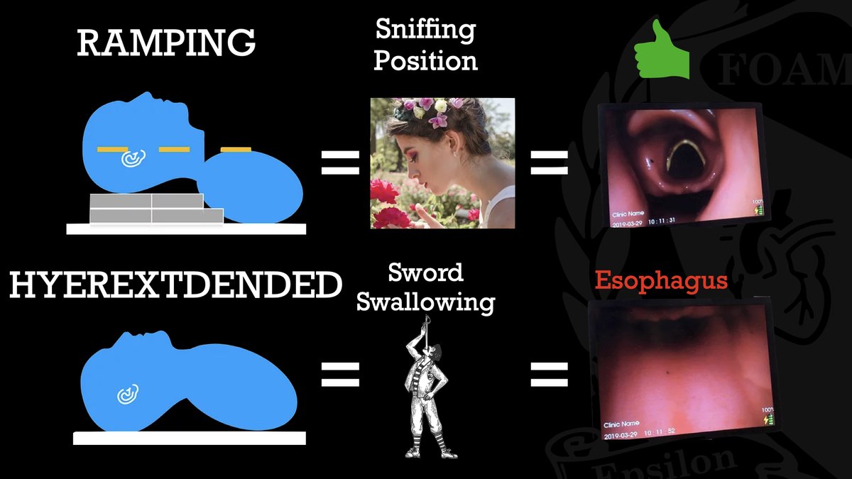 The sniffing position is often incorrectly used to describe the hyper-extended position, the position often taught to place the patient in to intubate. The hyperextended position is the position sword swallowers use, which easily allows the sword to be placed down the esophagus.