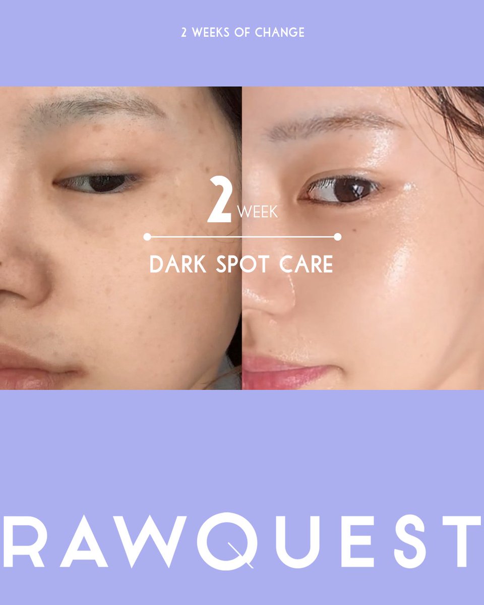 rawquest_'s tweet image. 기미 잡티 2주간 집중 타겟팅📌
기미 잡티 고민러들을 위한 추천!
✅ 집중 브라이트닝 제품이 필요하다면?
✅여름철 산뜻한 세럼이 필요하다면?
인텐스 브라이트닝 세럼이 정답☝️
로우퀘스트 인텐스 브라이트닝 세럼으로
2주간 자련스러운 톤/결/광 효과를 느껴보세요!
#로우퀘스트 #RAWQUEST…