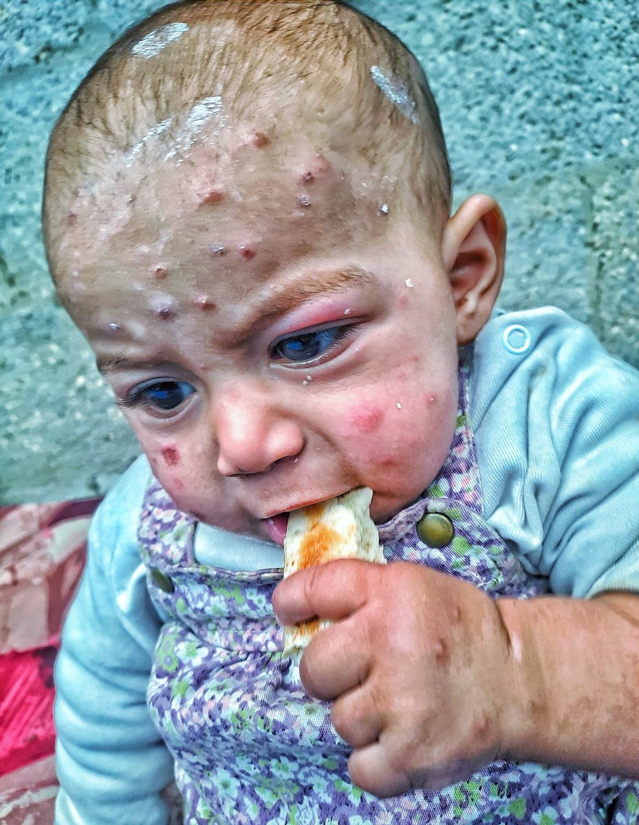 AbujomaaGaza's tweet image. Starvation, pollution, rubble, unsanitary tents, mosquitoes, germs, bacteria and continuous Israeli bombing!

Lack of food, medicine and medical treatment!