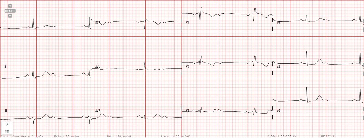 🧔‍♂️ 50 años que acude por sincope mientras estaba comiendo. El episodio fue hace 4 días y no consultó por no estropear la fiesta. En los último 2 días ha presentado mareo ocasional.

¿Diagnóstico y actitud?

Disfruta de los asaltos carprimur 👉carprimur.com/c/asalto-ecg/
#AsaltoECG