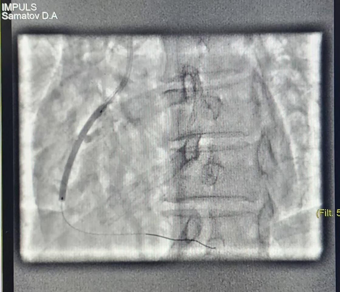 Clinical Case Feedback with Vesselin Drug-Coated Coronary Balloon Catheter in Uzbekistan

#metalfreePCI #InterventionalCardiology #DrugCoatedBalloon (#DCB) 

Contact us 📧>>marketing@lepu-medical.com 
Visit #lepumedical website for more >>en.lepumedical.com
