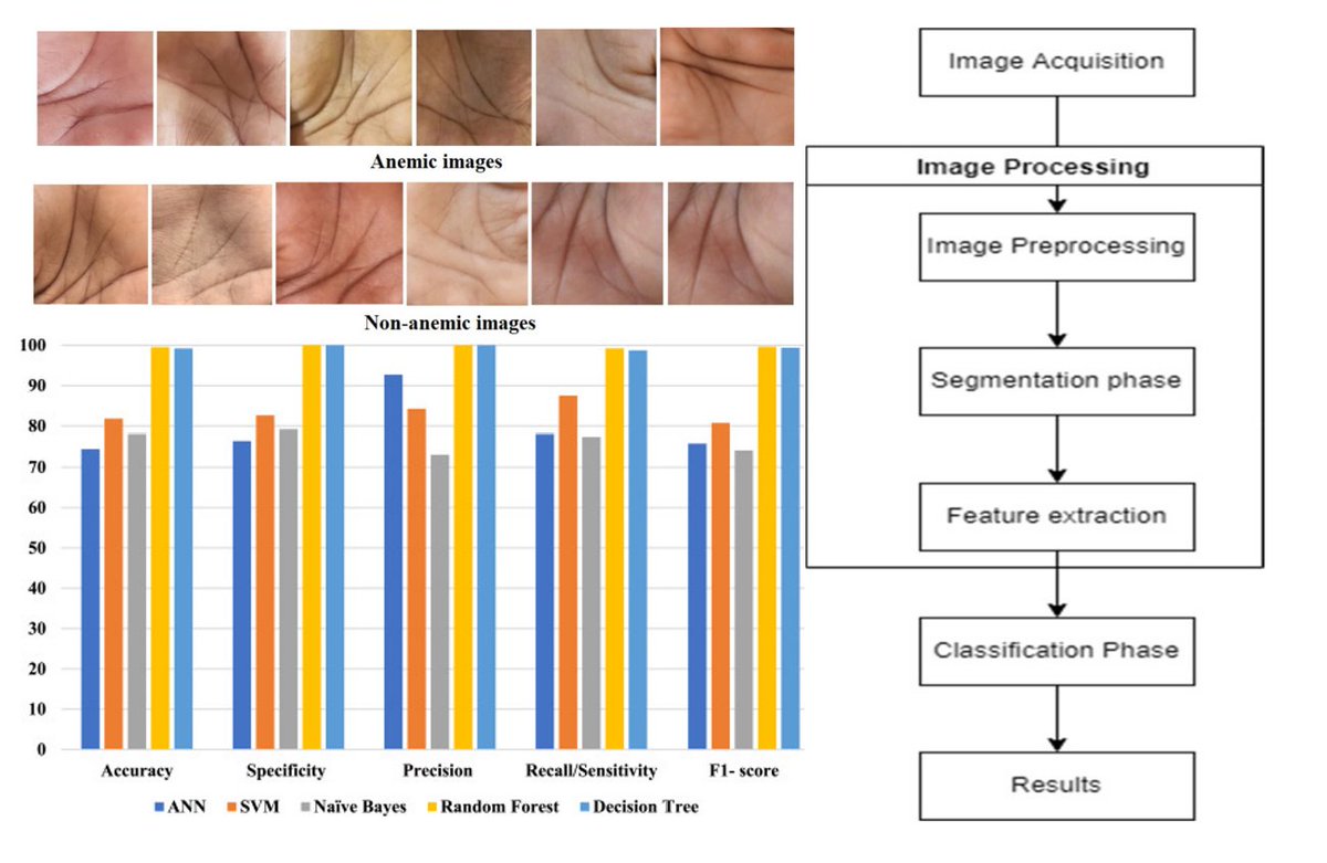 Application of ensemble models approach in anemia detection using images of the palpable palm sciencedirect.com/science/articl……… This paper focused on anemia detection using ensemble models in children #MedTwitter #scicomm #MedEd #AcademicTwitter