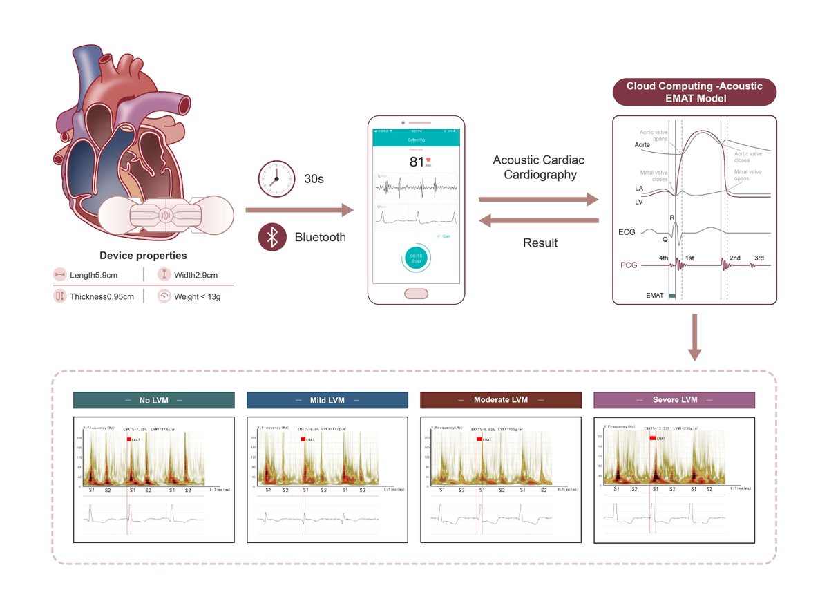 European Society of Cardiology Journals (@esc_journals) on Twitter photo A New Wearable e Monitoring Technology for Evaluation of Left Ventricular Remodeling after Transcatheter Aortic Valve Replacement ow.ly/Q4GM50VYJrh
#EHJDigital #mHealth <a href="/BruiningNico/">Nico Bruining EiC EHJ Digital Health</a> <a href="/rafavidalperez/">rafavidalperez</a> <a href="/fwasselbergs/">Folkert Asselbergs</a> <a href="/EAPCIPresident/">EAPCIPresident</a> A New Wearable e Monitoring Technology for Evaluation of Left Ventricular Remodeling after Transcatheter Aortic Valve Replacement ow.ly/Q4GM50VYJrh
#EHJDigital #mHealth <a href="/BruiningNico/">Nico Bruining EiC EHJ Digital Health</a> <a href="/rafavidalperez/">rafavidalperez</a> <a href="/fwasselbergs/">Folkert Asselbergs</a> <a href="/EAPCIPresident/">EAPCIPresident</a>