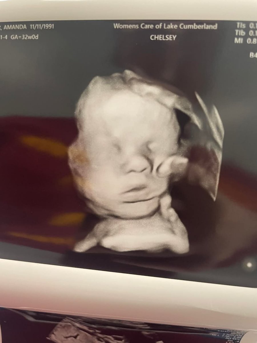 Hand of God shows up on womans ultrasound.

"She says that before each ultrasound, she would drop to her knees and ask God to place His hand on baby Kyler. 

During a recent scan, her young daughter noticed something unusual, what looked like a hand cradling the baby’s head."