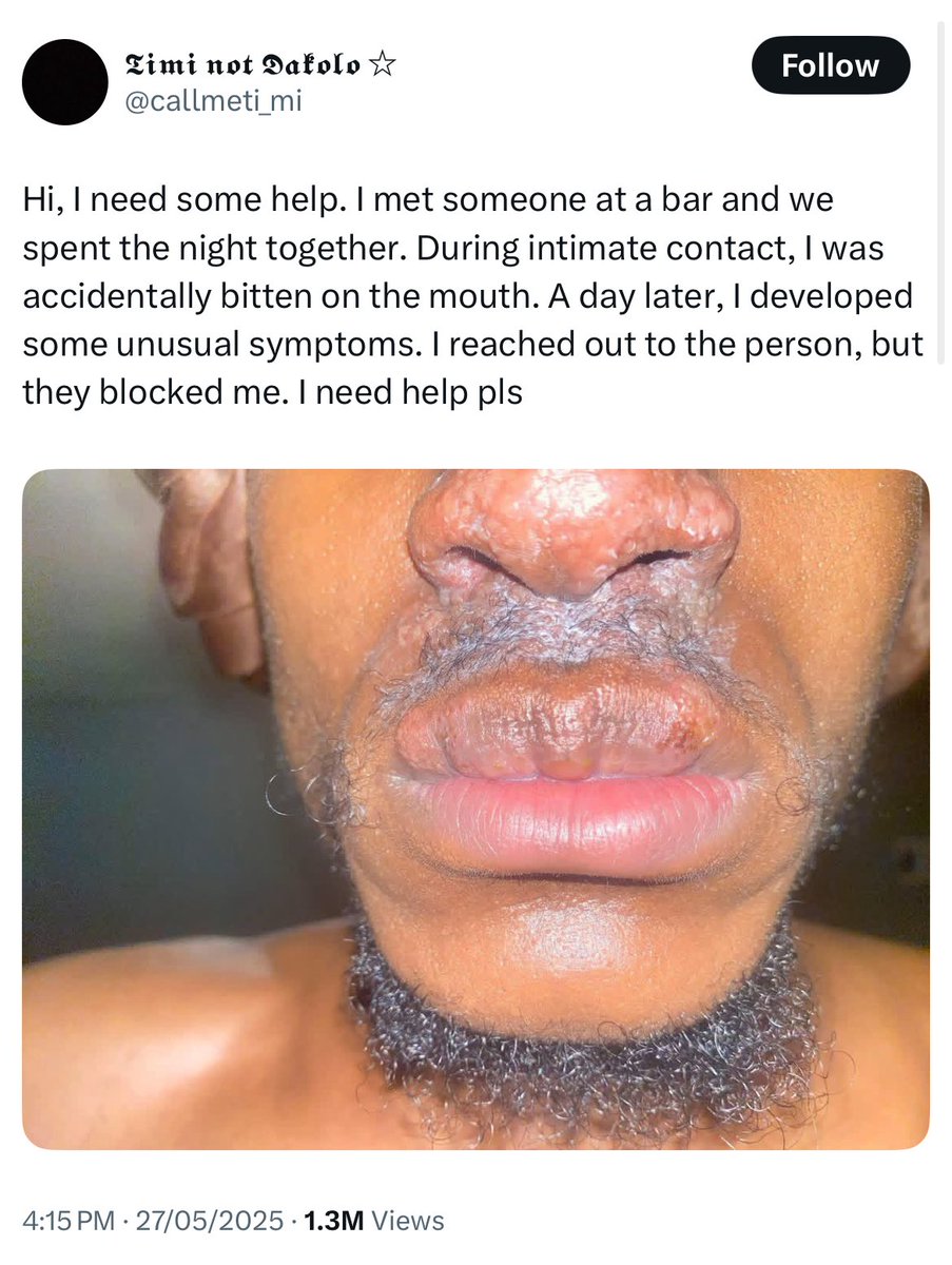 Naijawide01's tweet photo. Herpes is trending after a Nigerian estate surveyor posted a pic of a rash on his lip 👀

He claims a lady he met at a bar “accidentally” bit him during their hookup — next day, rash appeared. She blocked him. Twitter did the math.

Experts say: it’s Herpes. No cure, just management.

Be guided.