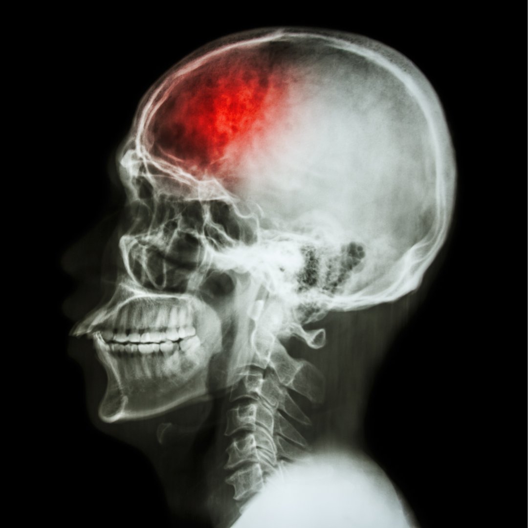 Rev_Cientifica's tweet photo. Internações por acidente vascular cerebral em mulheres, Roraima, Brasil

🌍📚 Leia o Artigo Completo em: 
https://t.co/SIFB6q9ppB https://t.co/f1aBi9aITf