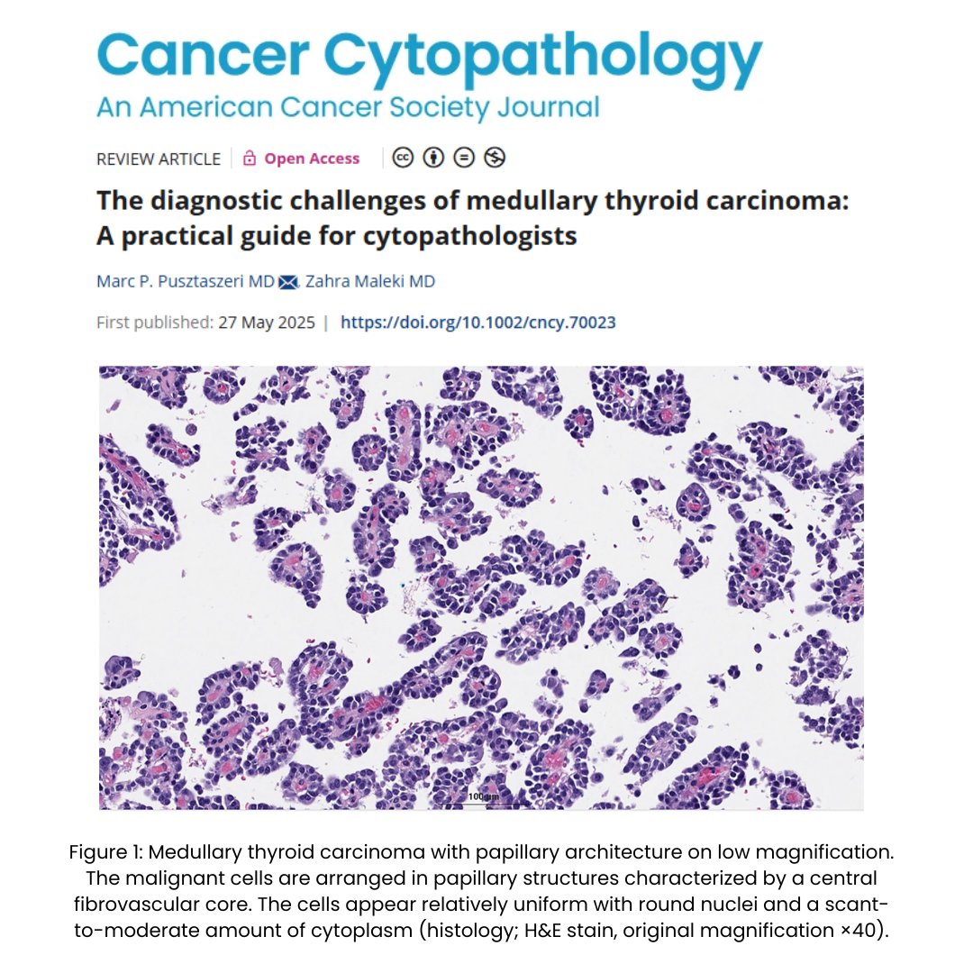 Cancer Cytopathology (@cancercytopath) on Twitter photo 🔓 New #OpenAccess review by Marc P. Pusztaszeri MD & <a href="/ZMaleki_cyto/">Zahra Maleki, MD, MIAC</a> offers practical guidance on diagnosing medullary thyroid carcinoma, covering cytologic features, ancillary studies, mimics, and pitfalls. 🔬
acsjournals.onlinelibrary.wiley.com/doi/10.1002/cn…
#CytoPath 🔓 New #OpenAccess review by Marc P. Pusztaszeri MD & <a href="/ZMaleki_cyto/">Zahra Maleki, MD, MIAC</a> offers practical guidance on diagnosing medullary thyroid carcinoma, covering cytologic features, ancillary studies, mimics, and pitfalls. 🔬
acsjournals.onlinelibrary.wiley.com/doi/10.1002/cn…
#CytoPath