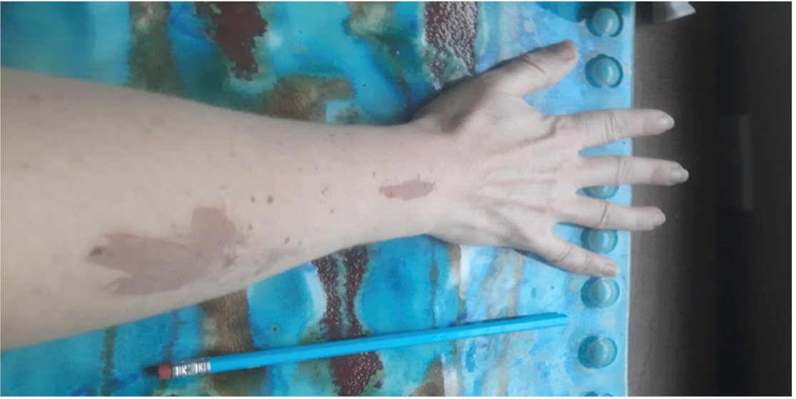 Academic Life in EM (@aliemteam) on Twitter photo ACMT Toxicology Visual Pearl: Not Very A-peel-ing
Which chemical, commonly used in chemical peels, can cause severe, gray colored skin burns upon direct contact?
Acetone
Hydrogen peroxide
Phenol
Salicylic acid
Read more: aliem.com/acmt-not-very-…
<a href="/acmtmedtox/">American College of Medical Toxicology</a> ACMT Toxicology Visual Pearl: Not Very A-peel-ing
Which chemical, commonly used in chemical peels, can cause severe, gray colored skin burns upon direct contact?
Acetone
Hydrogen peroxide
Phenol
Salicylic acid
Read more: aliem.com/acmt-not-very-…
<a href="/acmtmedtox/">American College of Medical Toxicology</a>