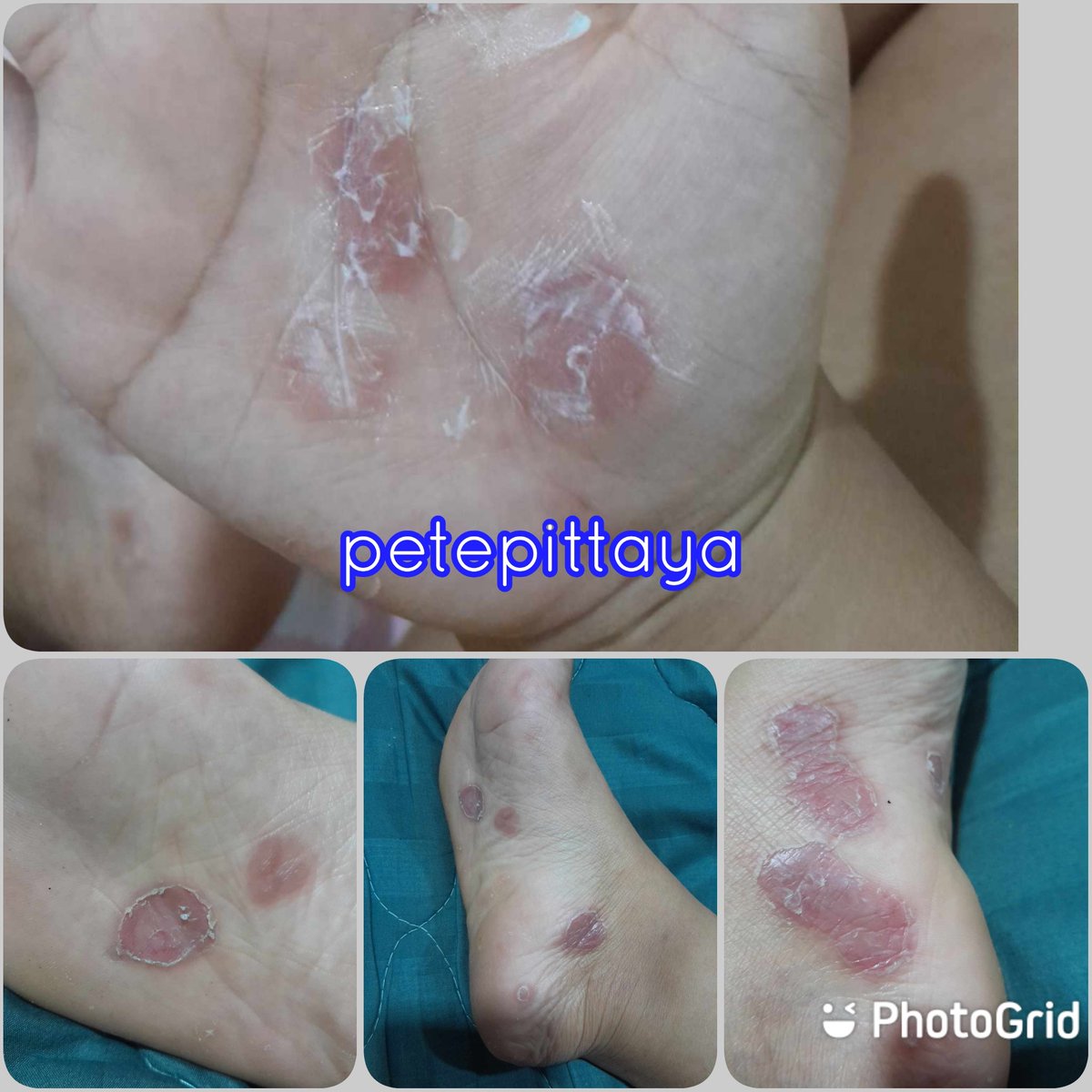 lekanoi's tweet photo. ใครที่ติดตาม Pete Pittaya มานานจะรู้ว่าซิฟิลิสมันระบาดตั้งแต่ปี 2010 เป็นต้นมาแต่ตอนนั้นระบาดแค่กรุงเทพ และปริมณฑล

แต่ตอนนี้ระบาดไปตามจังหวัดใหญ่ๆ และระบาดในกลุ่มวัยรุ่นซิฟิลิสมันติดต่อได้ง่าย ถึงแม้จะสวมถุงยางอนามัยแล้วก็ตาม 

มันติดจากการอม การดูด การเลีย และจูบปาก https://t.co/P8CpHPCy48