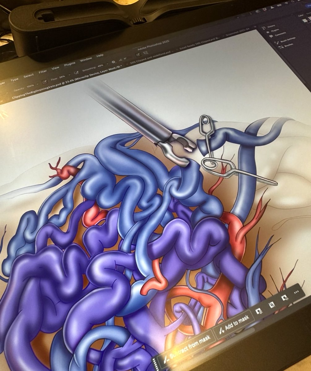 StephCohenMD's tweet image. Brain AVM illustration #InProgress