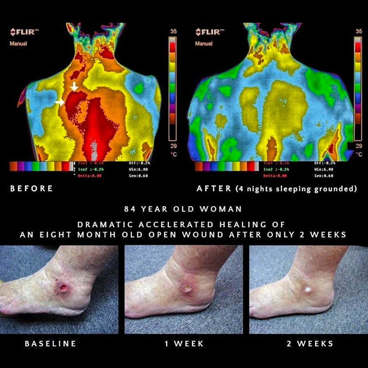 Most people think your body is just chemistry.

But it’s not just biochemical—it’s electrical. ⚡

And until you understand that, you'll miss a huge piece of why nature heals… and why modern life drains you.

A thread on grounding, electrons, and the human circuit board: 🧵
