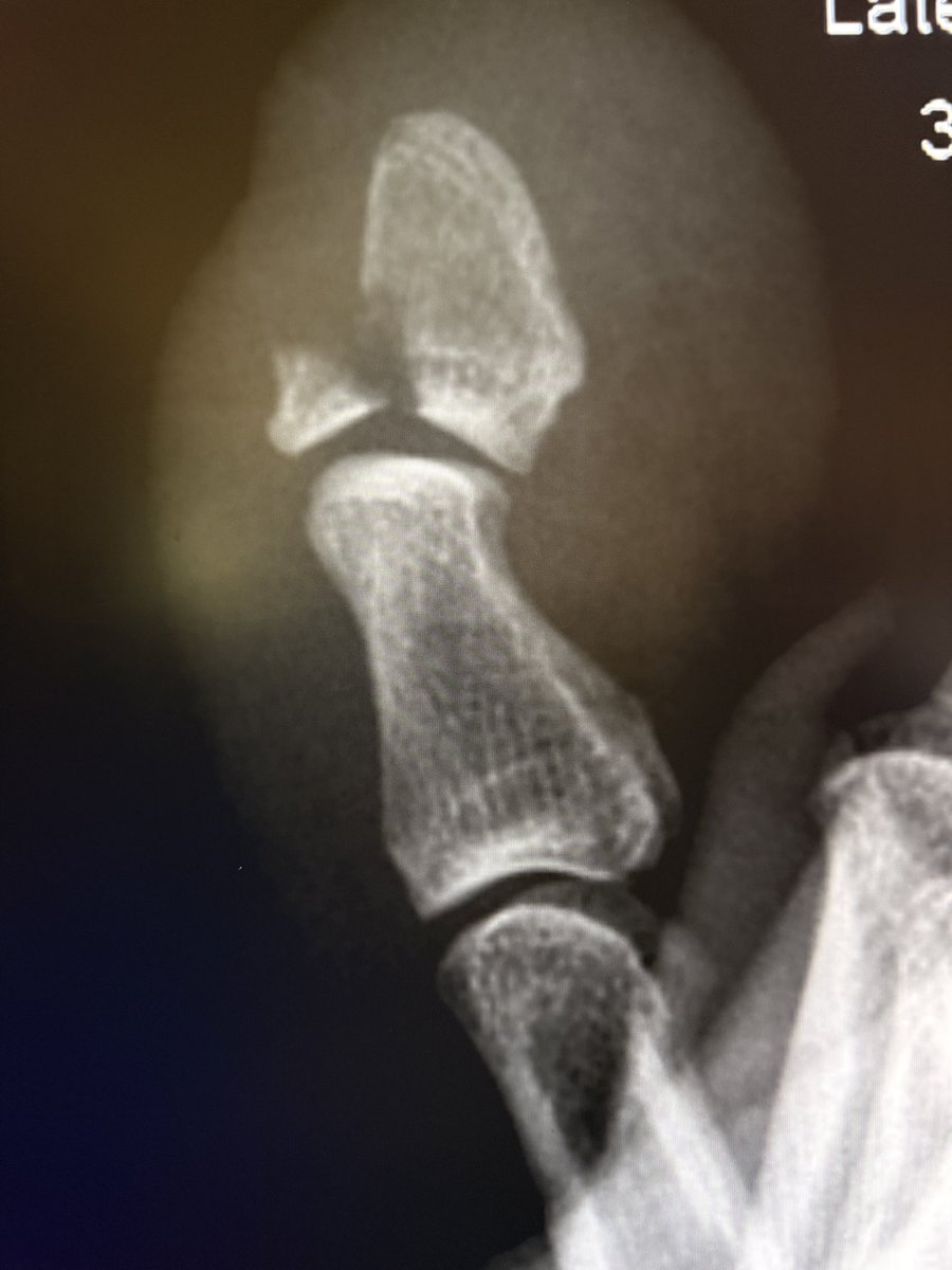 Nothing fancy today! 

One view is NO view! 

Finger avulsion fractures are often only seen on lateral view!