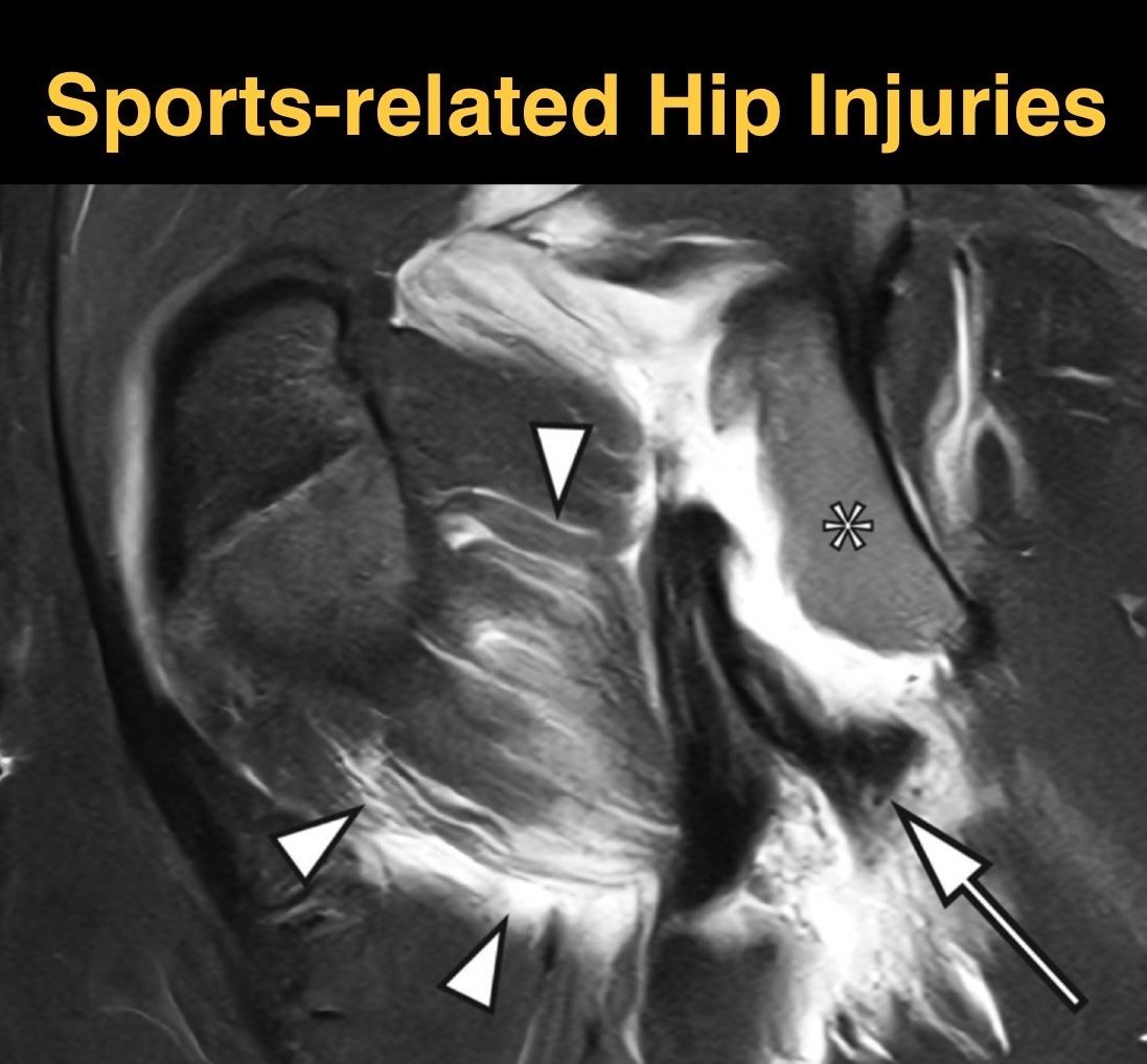 SutterBalgrist's tweet image. Happy to be part of the special #SportsImaging issue of @SMR_SeminarsMSK for #ESSR2025!
Read our article on Sports-related Hip Injuries here: doi.org/10.1055/s-0045…
#MSKrad @derbalgrist @UZH_ch