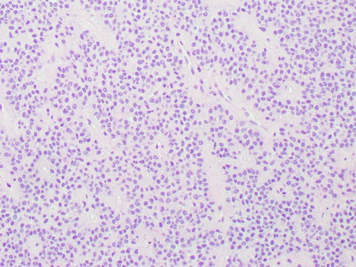 UTHoustonPath's tweet photo. Sellar mass resection from a 17 yo M, do you know the dx? 🤔🧠#Neuropath #PathX #PathTwitter https://t.co/L85NTWvrzN