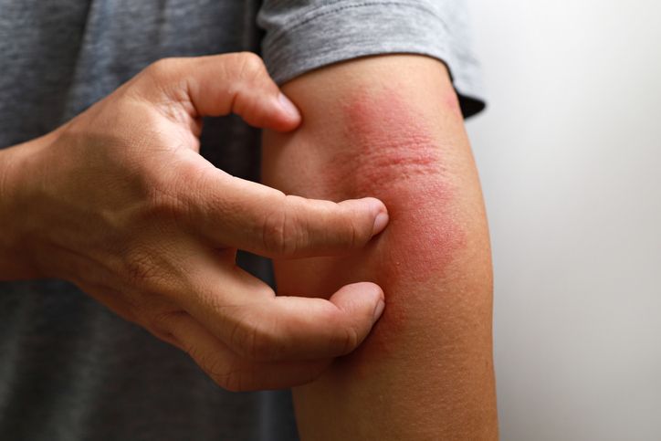 mydocwire's tweet image. 🚨 New eczema research is in!
🔍 Find out who benefits most from #lebrikizumab and when.
👉 Read more: buff.ly/HOxWrFg

#Eczema #Dermatology #Lebrikizumab #HealthNews #SkinCare
