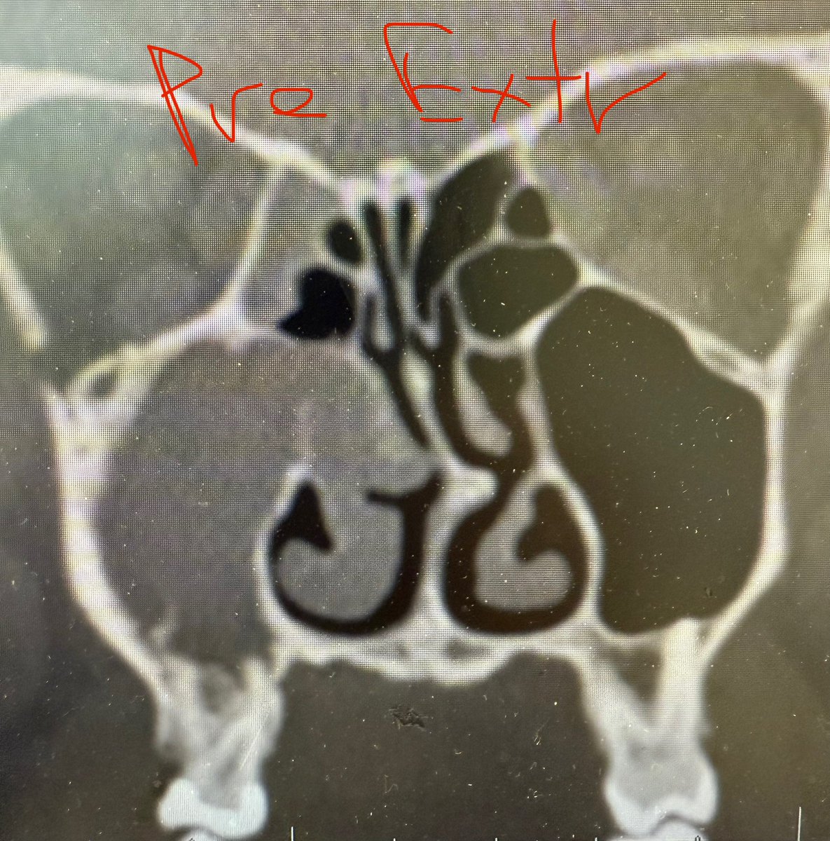 JohnCraigNose's tweet image. Even the blind 🐿️ gets the 🥜 sometimes w #ODS. Nice result here w #extraction alone. Must say I was surprised. Wouldn’t have been the most pleasant frontal (if you’d open it, hmm!); it’s actually even more interesting but not enough words to explain. @henryfordent @ent_ams…