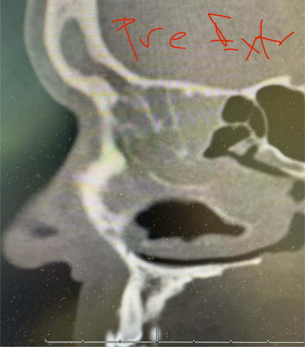 JohnCraigNose's tweet image. Even the blind 🐿️ gets the 🥜 sometimes w #ODS. Nice result here w #extraction alone. Must say I was surprised. Wouldn’t have been the most pleasant frontal (if you’d open it, hmm!); it’s actually even more interesting but not enough words to explain. @henryfordent @ent_ams…