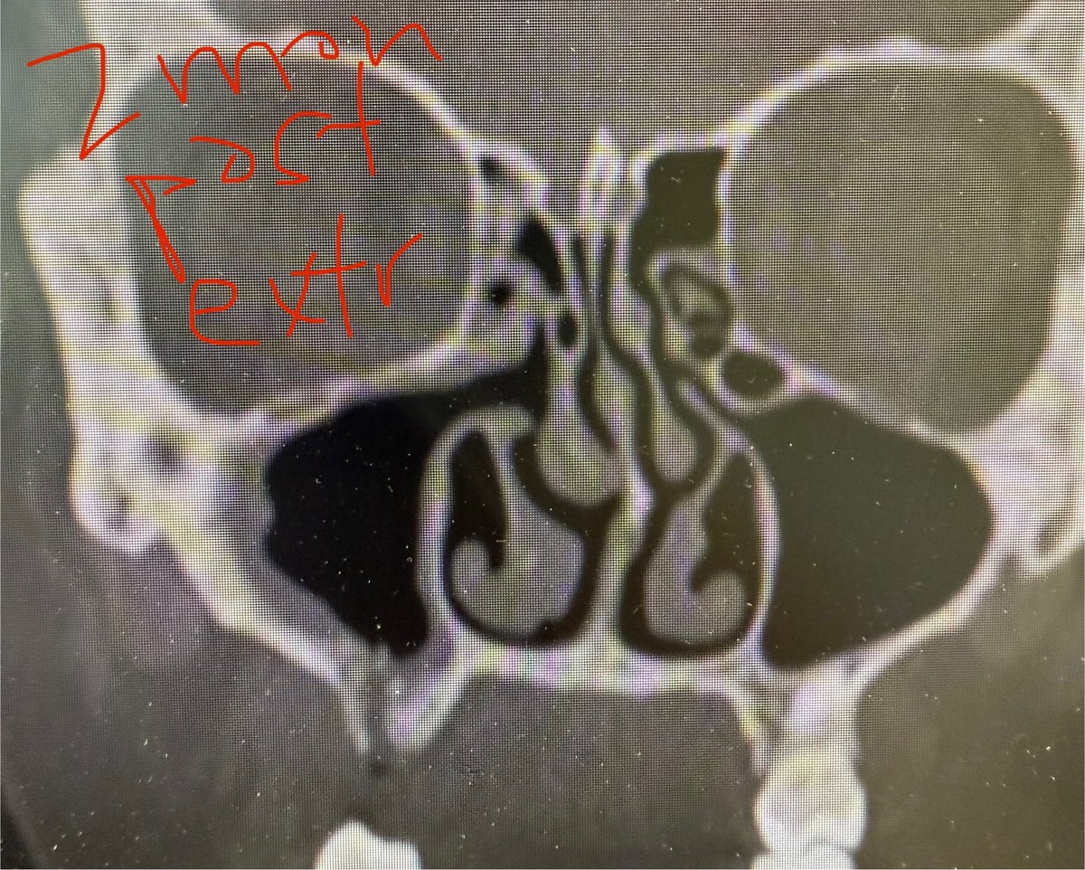 JohnCraigNose's tweet image. Even the blind 🐿️ gets the 🥜 sometimes w #ODS. Nice result here w #extraction alone. Must say I was surprised. Wouldn’t have been the most pleasant frontal (if you’d open it, hmm!); it’s actually even more interesting but not enough words to explain. @henryfordent @ent_ams…