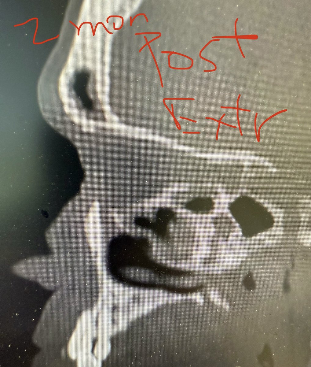 JohnCraigNose's tweet image. Even the blind 🐿️ gets the 🥜 sometimes w #ODS. Nice result here w #extraction alone. Must say I was surprised. Wouldn’t have been the most pleasant frontal (if you’d open it, hmm!); it’s actually even more interesting but not enough words to explain. @henryfordent @ent_ams…