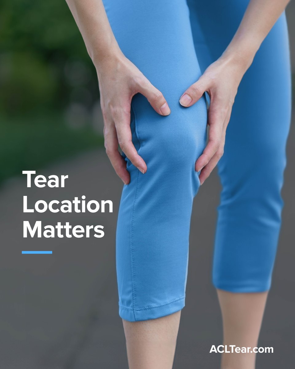 Arthrex's tweet image. Not all ACL tears can be repaired. Tear location plays a big role in determining ACL tear treatment, which includes reconstruction or repair. Swipe to see the different tear types.
Learn more: arthrex.info/43N9JAL
#KneeInjuries #MedicalEducation #Innovation #ACLTear