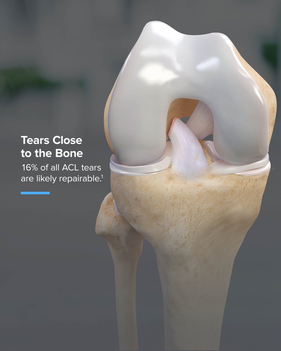 Arthrex's tweet image. Not all ACL tears can be repaired. Tear location plays a big role in determining ACL tear treatment, which includes reconstruction or repair. Swipe to see the different tear types.
Learn more: arthrex.info/43N9JAL
#KneeInjuries #MedicalEducation #Innovation #ACLTear