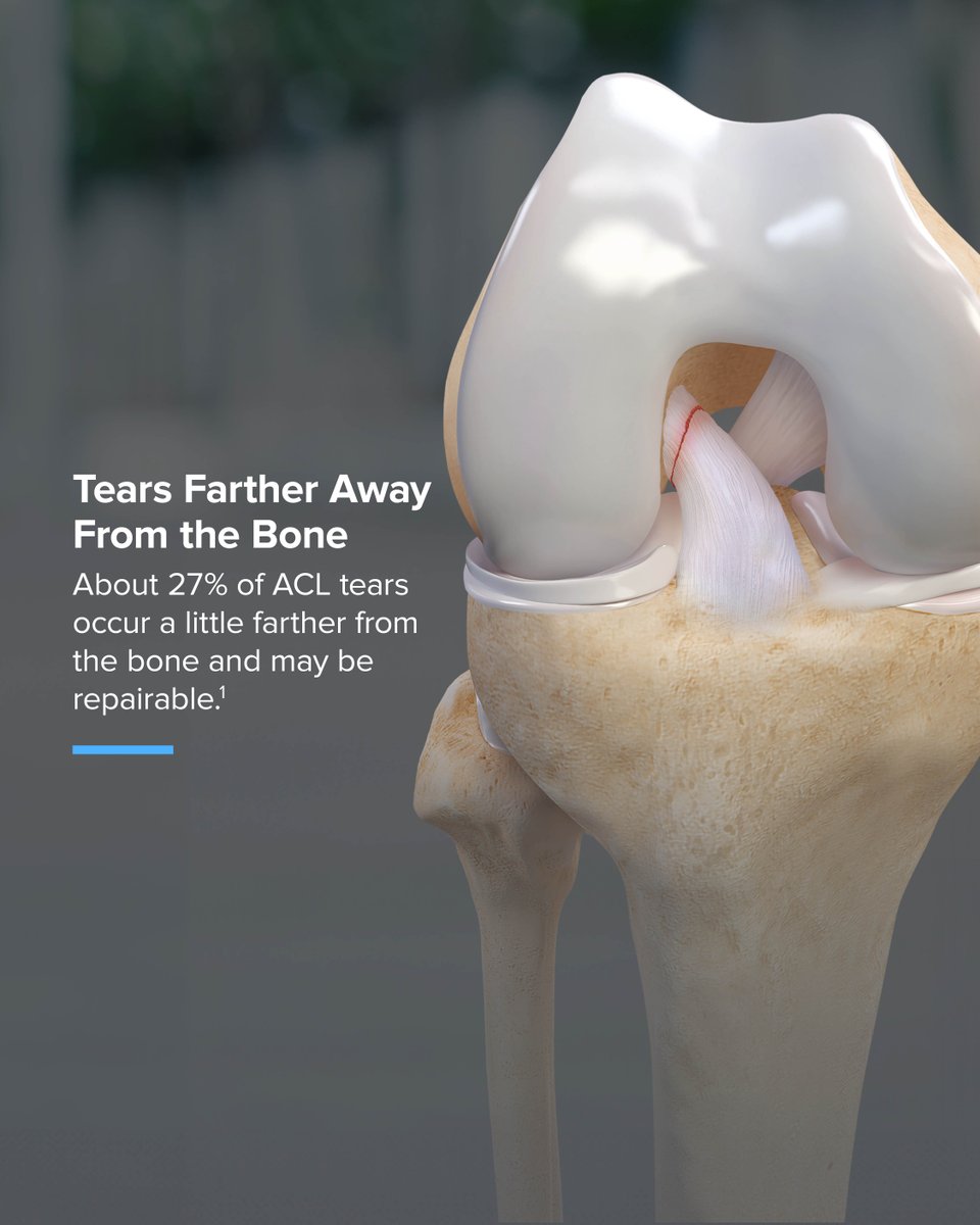 Arthrex's tweet image. Not all ACL tears can be repaired. Tear location plays a big role in determining ACL tear treatment, which includes reconstruction or repair. Swipe to see the different tear types.
Learn more: arthrex.info/43N9JAL
#KneeInjuries #MedicalEducation #Innovation #ACLTear