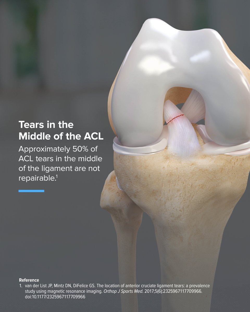 Arthrex's tweet image. Not all ACL tears can be repaired. Tear location plays a big role in determining ACL tear treatment, which includes reconstruction or repair. Swipe to see the different tear types.
Learn more: arthrex.info/43N9JAL
#KneeInjuries #MedicalEducation #Innovation #ACLTear