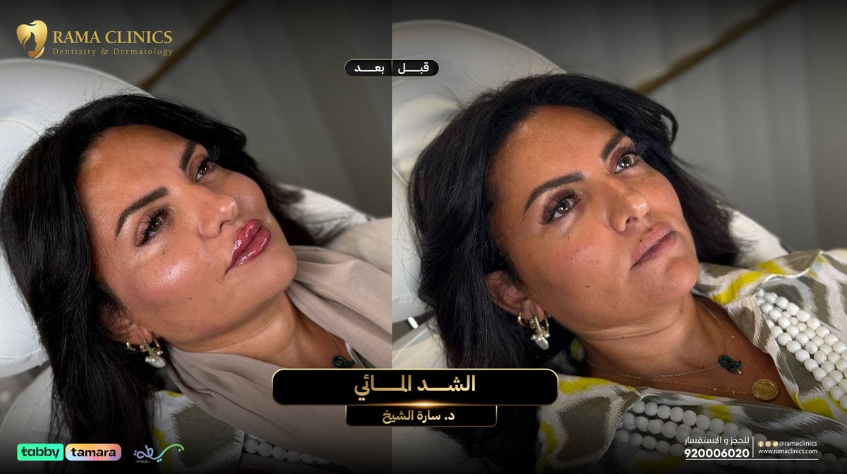 حالة الشد المائي مع د.سارة الشيخ 💕
الحين راح تستفيدي بكاش باك 10% راجعين لك لما تشتري عروضنا من تطبيق راما أونلاين 
#كاش_باك #كونتور #عيادات_تجميل #عيادات_جدة #فيلر #فيلر_شفايف #فيلر_خدود #فيلر_تحت_العين #فيلر_الوجه #تكساس #تحديد_فك #ابراز_الذقن #عروض #عالمك_الخاص #rama_clinics