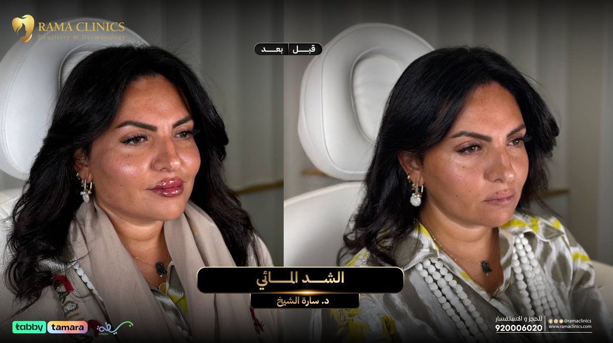 ramaclinics's tweet photo. حالة الشد المائي مع د.سارة الشيخ 💕
الحين راح تستفيدي بكاش باك 10% راجعين لك لما تشتري عروضنا من تطبيق راما أونلاين 
#كاش_باك #كونتور #عيادات_تجميل #عيادات_جدة #فيلر #فيلر_شفايف #فيلر_خدود #فيلر_تحت_العين #فيلر_الوجه #تكساس #تحديد_فك #ابراز_الذقن #عروض #عالمك_الخاص #rama_clinics https://t.co/mcnphnOaq4