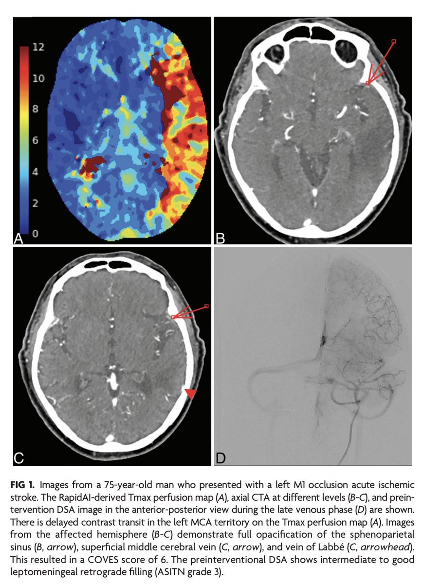 TheAJNR's tweet image. "The Cortical Vein Opacification Score (COVES) Is Independently Associated with DSA ASITN Collateral Score"

doi.org/10.3174/ajnr.A…

#COVES @dhairyalakhani