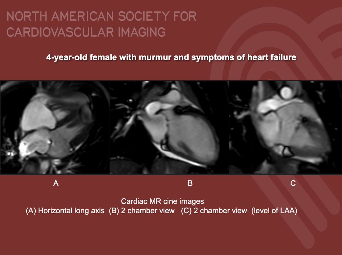 NASCI (@nascisociety) on Twitter photo #NASCI Case Series
Case 79
Courtesy of @AndreaFurlaniMD from Montefiore Medical Center, NY
What is the right answer?
#whyCMR #YesCCT
<a href="/GregKicska/">Gregory Kicska</a> <a href="/JRevRad1/">Jonathan Revels DO, FSAR</a> <a href="/dianalitmano/">diana litmanovich</a> <a href="/DanielVargasMD/">Daniel Vargas, MD</a> <a href="/kirschj/">Jacobo Kirsch, MD, MBA, FACR</a> <a href="/prachipagarwal/">Prachi Agarwal</a> <a href="/AwsHamid5/">Aws Hamid, MD, MS</a> <a href="/EscrOffice/">ESCR Vienna</a> <a href="/CarlottaOnnis/">Carlotta Onnis</a> <a href="/DeCeccoCN/">Carlo N. De Cecco, MD, PhD</a> #NASCI Case Series
Case 79
Courtesy of @AndreaFurlaniMD from Montefiore Medical Center, NY
What is the right answer?
#whyCMR #YesCCT
<a href="/GregKicska/">Gregory Kicska</a> <a href="/JRevRad1/">Jonathan Revels DO, FSAR</a> <a href="/dianalitmano/">diana litmanovich</a> <a href="/DanielVargasMD/">Daniel Vargas, MD</a> <a href="/kirschj/">Jacobo Kirsch, MD, MBA, FACR</a> <a href="/prachipagarwal/">Prachi Agarwal</a> <a href="/AwsHamid5/">Aws Hamid, MD, MS</a> <a href="/EscrOffice/">ESCR Vienna</a> <a href="/CarlottaOnnis/">Carlotta Onnis</a> <a href="/DeCeccoCN/">Carlo N. De Cecco, MD, PhD</a>