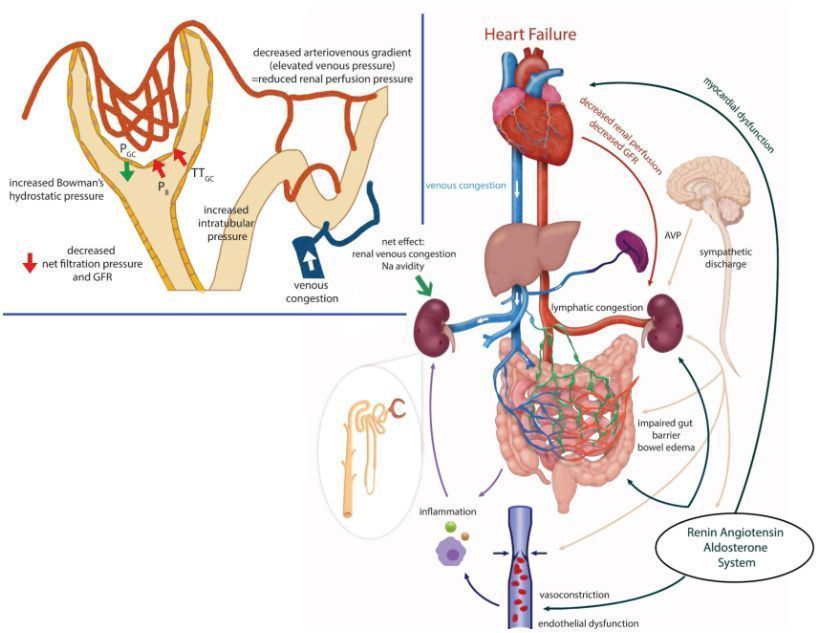 AJKD (@ajkdonline) on Twitter photo This Core Curriculum explores commonly implicated pathophysiological mechanisms in kidney dysfunction in heart failure and discuss principles behind effective decongestion and assessment of adequacy of natriuresis:
bit.ly/434spfa (FREE)
<a href="/KevinBryanLo/">Kevin Bryan Lo</a> <a href="/UVoverP/">A. Janakiraman</a> <a href="/RangaswJ/">Janani Rangaswami</a> This Core Curriculum explores commonly implicated pathophysiological mechanisms in kidney dysfunction in heart failure and discuss principles behind effective decongestion and assessment of adequacy of natriuresis:
bit.ly/434spfa (FREE)
<a href="/KevinBryanLo/">Kevin Bryan Lo</a> <a href="/UVoverP/">A. Janakiraman</a> <a href="/RangaswJ/">Janani Rangaswami</a>