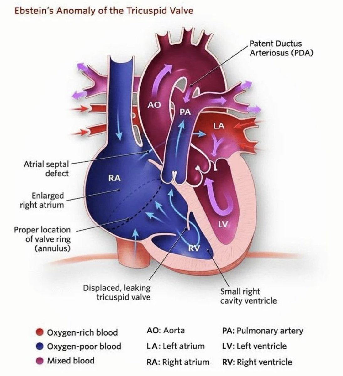 Zain Khalpey, MD, PhD, FACS (@zainkhalpey) on Twitter photo The tricuspid valve often gets overlooked—until it doesn’t.
Ebstein’s Anomaly shows us why early detection matters.
A displaced valve, regurgitation, and mixed blood flow can lead to serious complications if missed.
<a href="/AldecoBravo/">Leticia bravo Aldecoa 🧠& ♥</a>
#Cardiology #EarlyDetection The tricuspid valve often gets overlooked—until it doesn’t.
Ebstein’s Anomaly shows us why early detection matters.
A displaced valve, regurgitation, and mixed blood flow can lead to serious complications if missed.
<a href="/AldecoBravo/">Leticia bravo Aldecoa 🧠& ♥</a>
#Cardiology #EarlyDetection